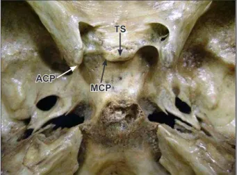 Figure 2. Internal view of skull with absence of the ossified ligament  between  anterior  and  middle  clinoid  processes