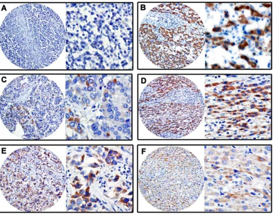 Figure 3. Protein expression patterns of SIRT3 in HCC tissues by IHC. The immunoreactivities were primarily observed in cytoplasm within tumor and normal liver cells