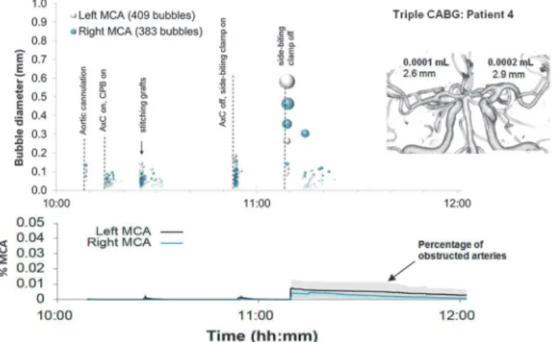Fig 3. Timing and diameters of bubbles in a 60 year old patient during Triple CABG. Markers denote individual embolic events where the y-axis and marker size indicate estimated bubble diameter