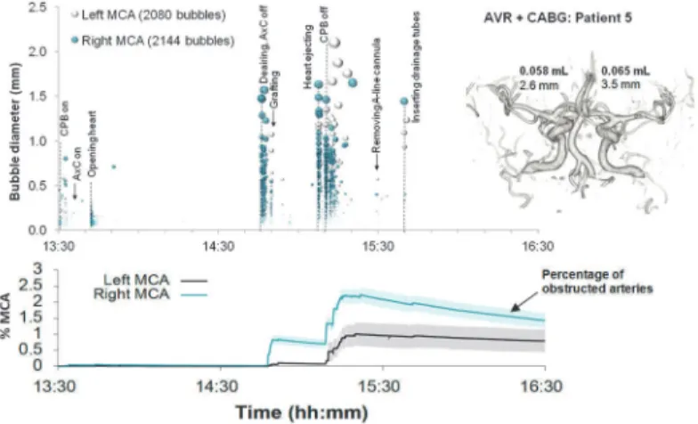 Fig 6. Timing and diameters of bubbles in a 55 year old patient during combined AVR and CABG.