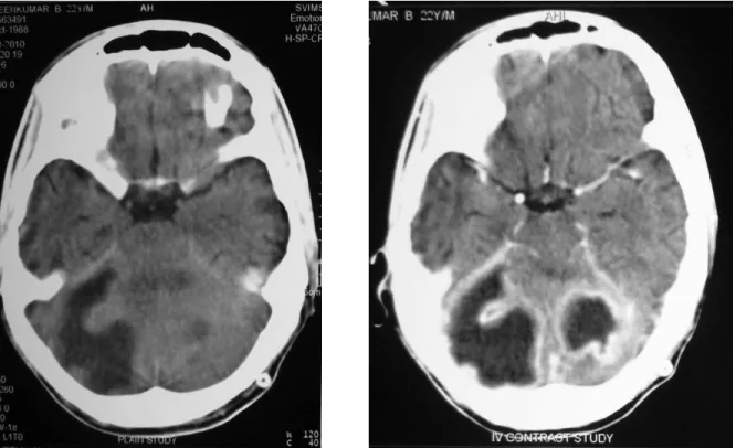 Figure 1: Cerebellar abscess. A 22-year-old  male presented with headache, vomitings and fever  of 1 week duration.