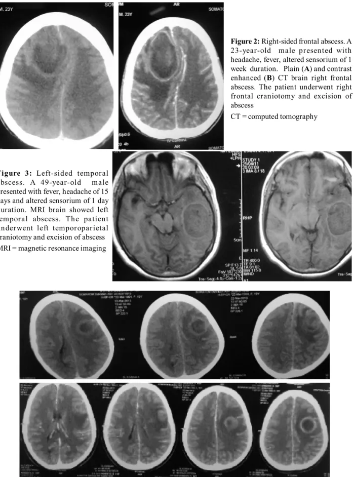 Figure 2: Right-sided frontal abscess. A 23-year-old    male  pr esen ted  with headache, fever, altered sensorium of 1 week  duration