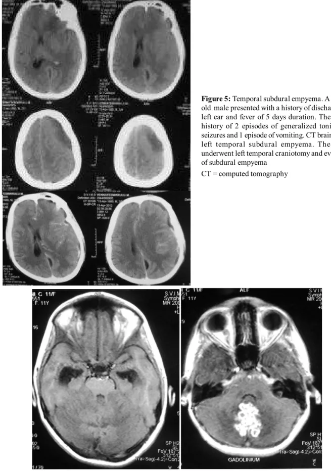Figure 5: Temporal subdural empyema. A 32-year- 32-year-old  male presented with a history of discharge from left ear and fever of 5 days duration