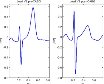 Fig. 6 Another example of CABG-induced changes in ECG:  