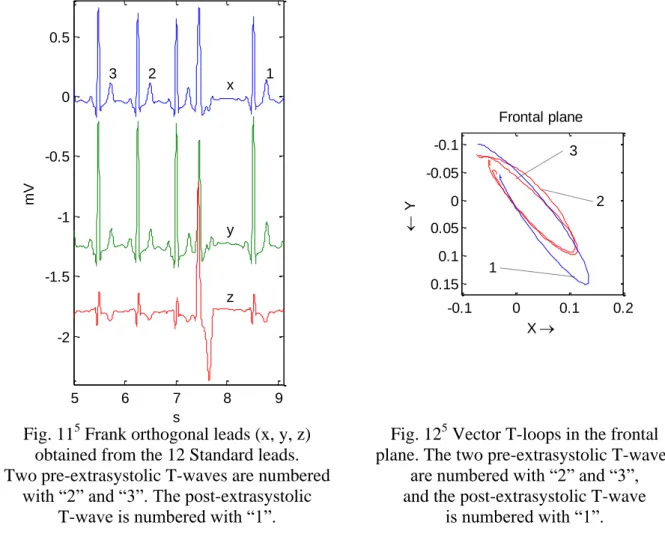 Fig. 12 5  Vector T-loops in the frontal  plane. The two pre-extrasystolic T-waves 