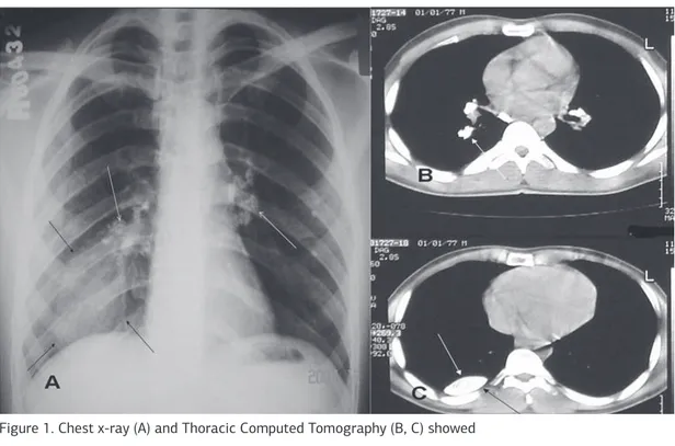 Figure 1. Chest x-ray (A) and Thoracic Computed Tomography (B, C) showed