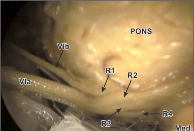 Figure 3.  A  schematic  diagram  of  the  multiple  roots  of  the  left  abducent  nerve
