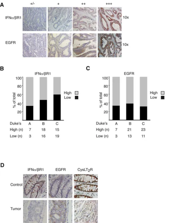 Figure 5. Representative IFNa/bR1 and EGFR staining in normal human colon tissue and colorectal adenocarcinomas