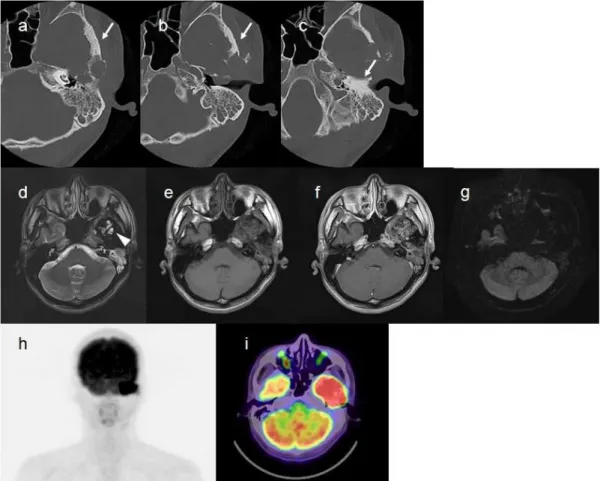 Figure 1.   Imaging  findings  of  case  number  1.  Bone-window  CT  images  (a-c)  show  temporal  bone  defects  and  sclerotic  changes  (white arrows) around the tumor