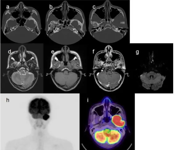 Figure 3 . Imaging findings of case number 2. Bone-window CT images (a-c), MRI (d, T2-weighted image; e, T1-weighted image; f,  gadolinium contrast-enhanced T1 weighted image; g, diffusion-weighted image), and  18 F-FDG PET/CT (h,  maximum-intensity-projec