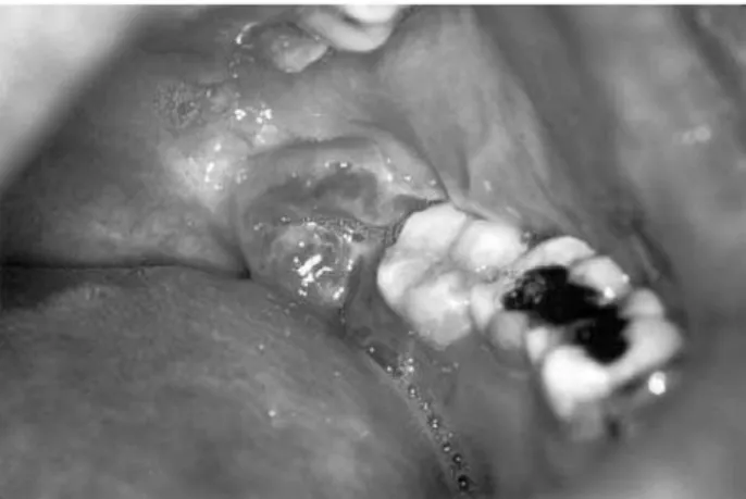Fig. 4 − Behind the third molar there is an ulcerous lesion, which may be confused as a stage of pericoronitis.