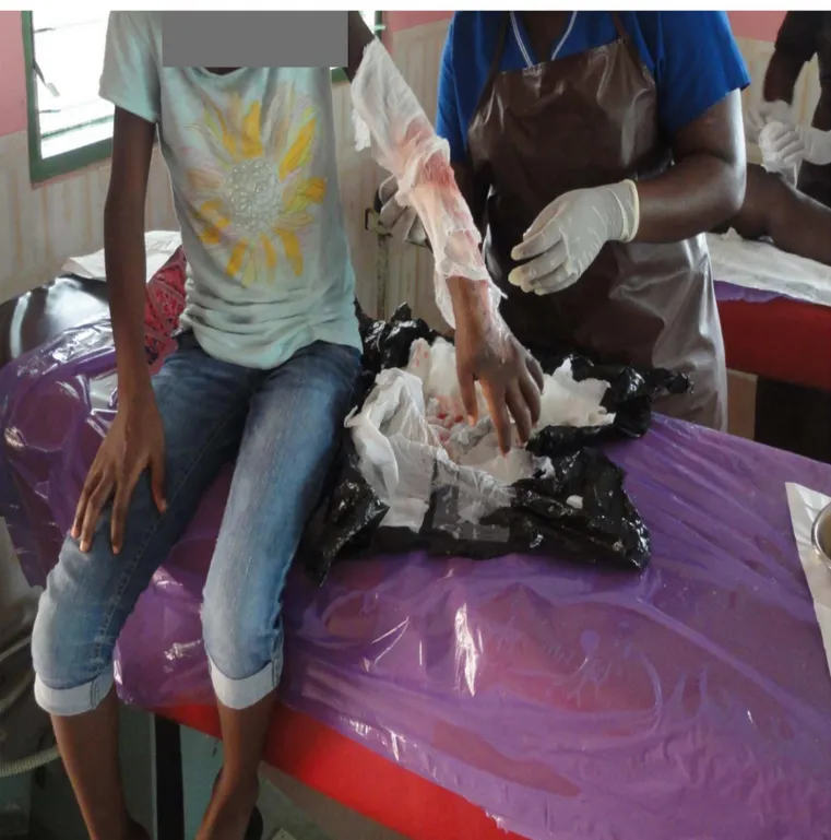 Fig 1. Dressing of buruli ulcer wound at a health centre.