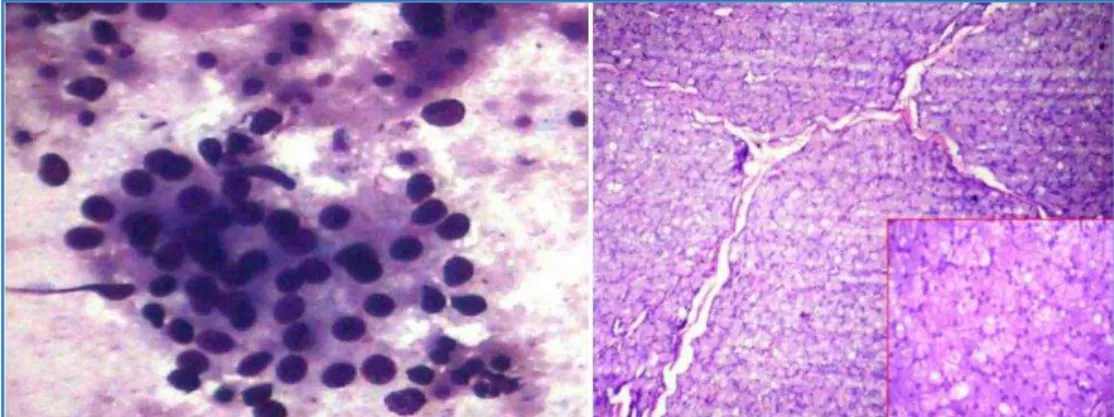 Fig. 3: Basal cell adenocarcinoma: both cytology and histopathology correlated 