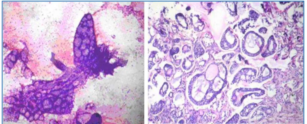 Fig. 6: Cytology reported as carcinoma. ex pleomorphic adenoma,   histopathology showed pleomorphic adenoma 