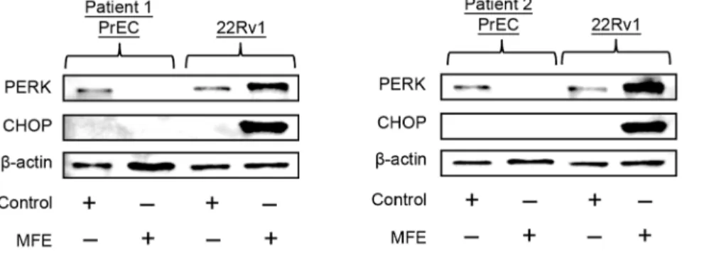 Figure 5. The effects of MFE on Prostate epithelial cells (PrECs) from prostate cancer patients