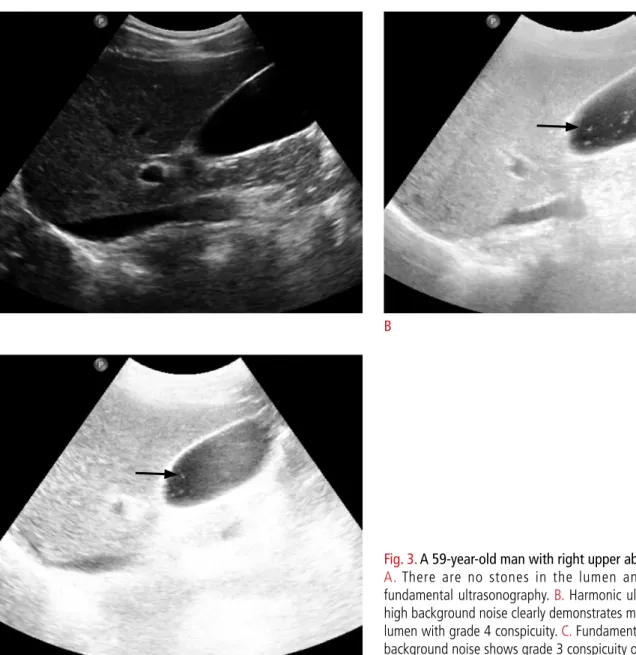 Table 2. Conspicuity of two diferent ultrasonography techniques  in the assessment of microcrystals in the gallbladder