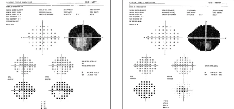 Figure 1. Humphrey SS visual field 24-2 of the patient with advanced retinitis pigmentosa