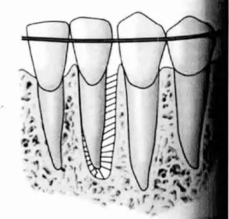 Figura 7 —  Dente submetido a movimento ortodôntico de translação. 