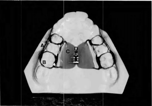 Figura 1 — Partes constituintes do aparelho de disjunção maxilar preconizado por Haas