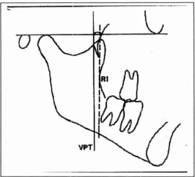 FIGURA  01 —  Mostra  o  ponto  R1  na parte mais  Iprofunda  da curvatura da borda  anterior do ramo