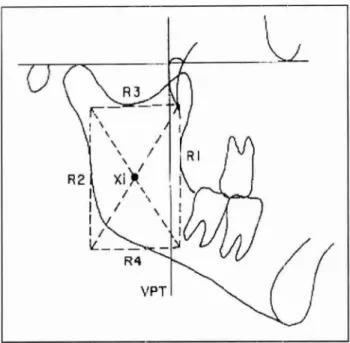FIGURA 05 — Mostra  o  ponto Xi localizado no centro do ramo da  mandíbula  RICKETTS59'29