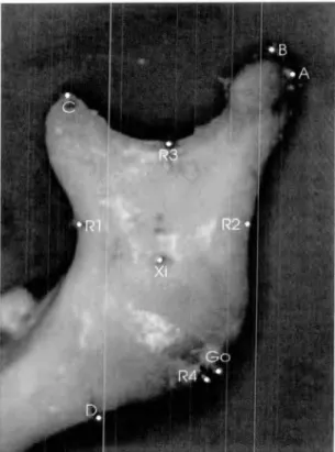 FIGURA 07 - Vista lateral esque -da do ramo da  mandíbula  com visualização dos  implantes metálicos ( exceto  o  do ponto Al ) em  cabeça  humana de cadáver