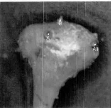 FIGURA 09 — Vista posterior do ceindilo mandibular com visualização dos implantes  metálicos em cabeça humana de cadáver 