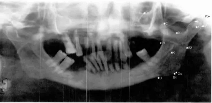 FIGURA 11 — Radiografia panorárnica com os implantes metálicos 