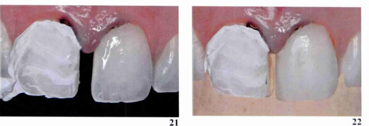 Figura 21: t feita a proteção do dente vizinho com veda-rosca para a realização dos  procedimentos restauratórios separadamente