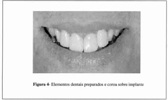 Figura 4-  Elementos dentais preparados  e  coroa sobre implante 