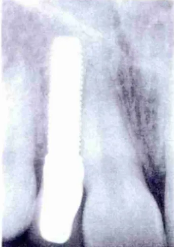 FIGURA 7- Radiografia periapical feita pela técnica  do  paralelismo. 