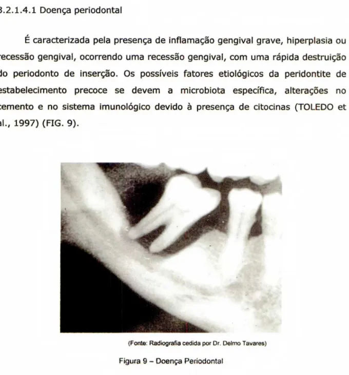 Figura  9 -   Doença   Periodontal 