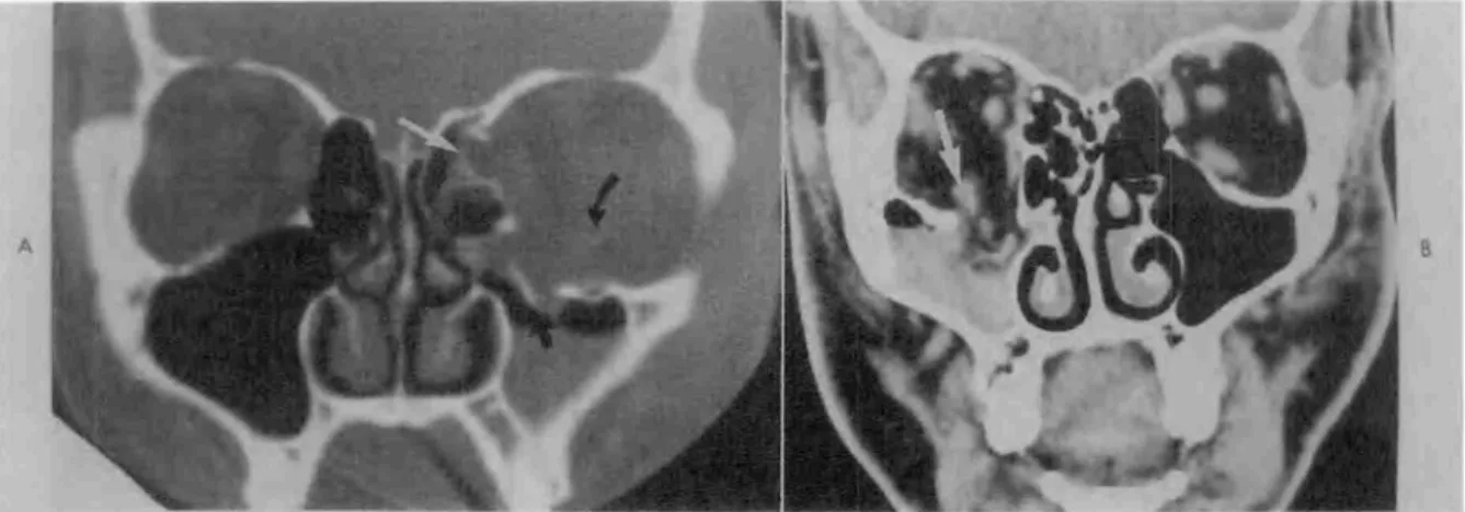 Figura  2 —  Fratura explosiva inferior. Em A, a imagem de TC  coronal  em janela  óssea,  mostra  o aspecto  de  &#34;alçapão&#34; 