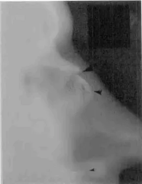 Figura 9 — Incidência lateral dos ossos nasais. Hi uma fratura transversa  (ponta  de seta superior)  atraves da  porção   anterior dos ossos nasais, com a depressão do fragmento distal  (ponta  de seta media)