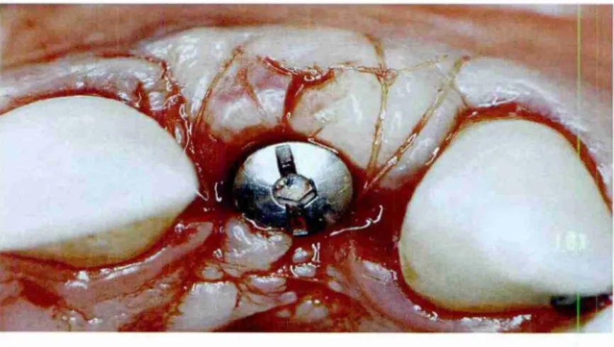 Fig  09:  Enxerto conjuntivo suturado em  posição. 