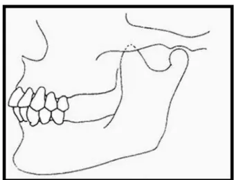 Fig. 2: Arco dental reduzido até os segundos pré-molares.  