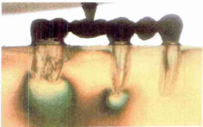 Figura  3b — Seqüência  de  aplicação  de carga vertical  em diferentes  localizações  sobre uma  prótese  com  conector   semi -rígido   por  distal do pilar   intermediário