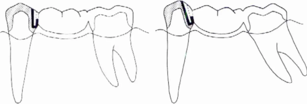 Figura 4 — Orientação  tradicional de um conector  Figura 5 — Orientação  convencional com molar inclinado 