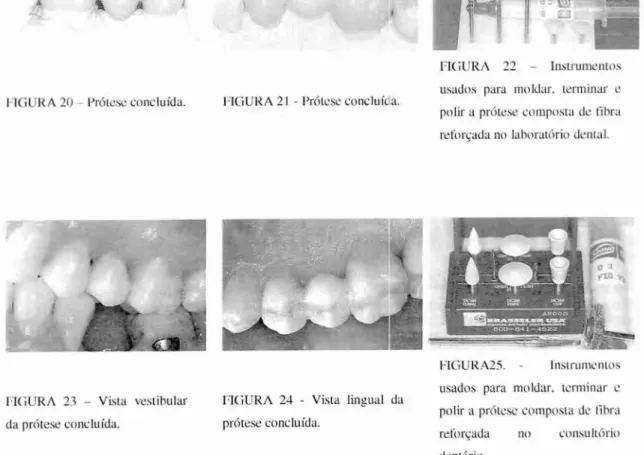 FIGURA 22 — Instrumentos  usados  para moldar ,   terminar  e  polir a prótese composta de Libra  reforçada no labmatório dental