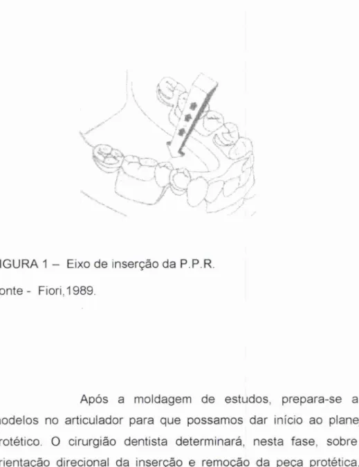 FIGURA 1 — Eixo de inserção da P.P.R. 