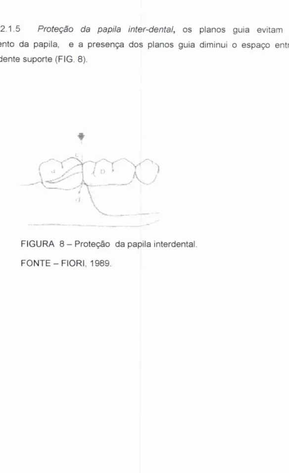 FIGURA 8 —  Proteção  da papila interdental. 