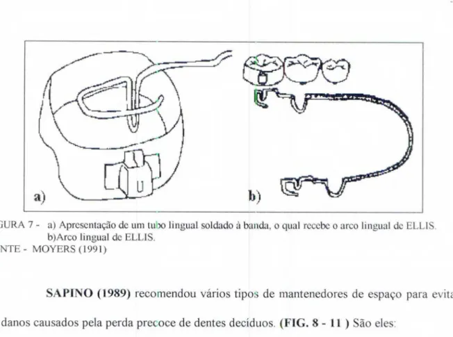 FIGURA  7 -  a)  Apresentação  de um tubo lingual soldado A.  banda,  o  qual  recebe  o  arco lingual de ELLIS