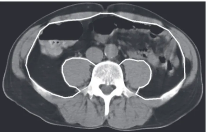 Fig 2. The image illustrates how the area of visceral adipose tissue (VAT) within the abdominal cavity (white line) was determined by CT scanning