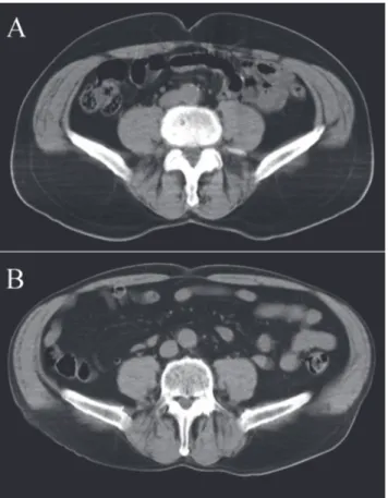 Fig 4. Patient examples with the same body mass index (BMI) and normal or increased (>188.4 cm 2 for men) areas of visceral adipose tissue (VAT)
