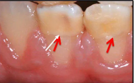 Figura 2 - Opacidade difusa nos dentes 41 e 42 ( Gentileza Drª T. Triches) 