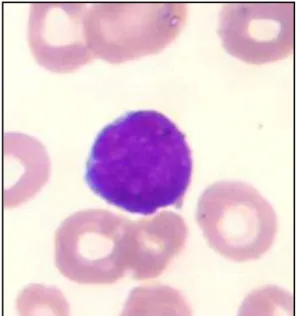 Figura 2 - Esfregaço de sangue periférico com blasto de um paciente com LLA. 