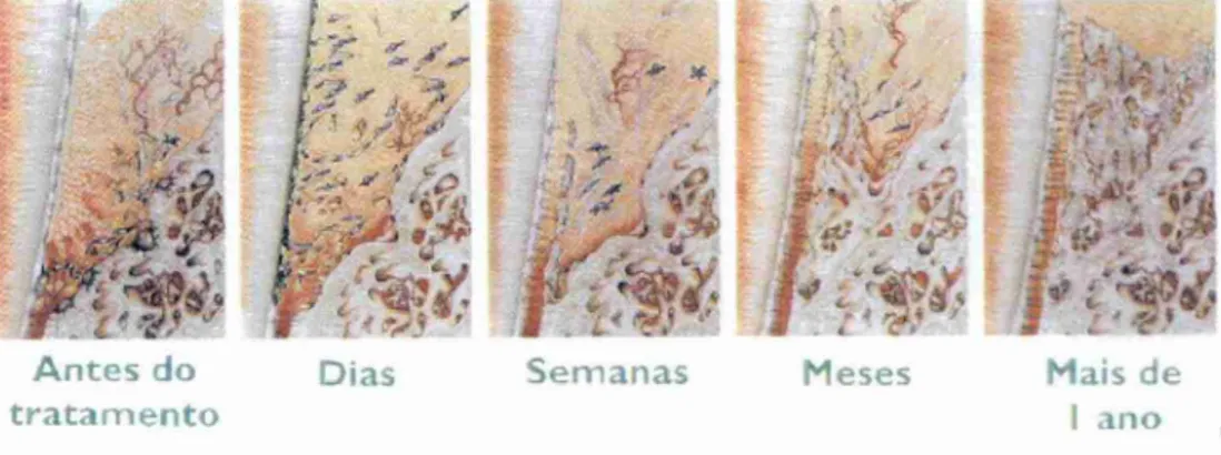 Figura  10  Resultados esperados  após aplicação  do  EMDOGAIN®,  dias, semanas, meses  e  um ano