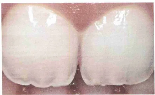 Fig. 11: Fotografia dental mostrando a translucidez do esmalte na Area  incisal. (Dario Adolfi, 2002)