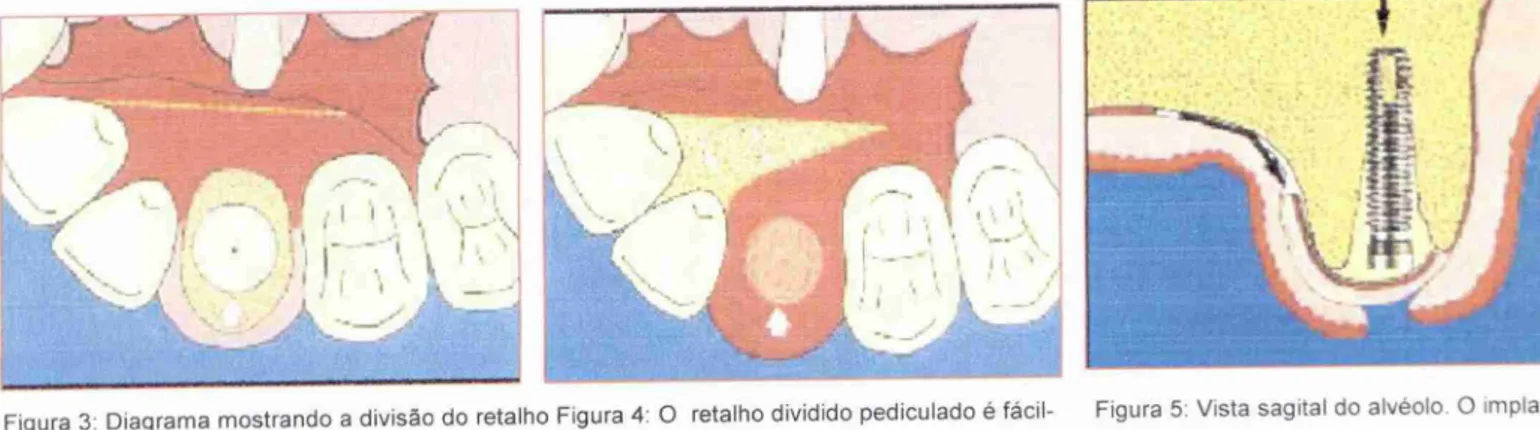 Figura  3:  Diagrama mostrando a  divisão  do retalho Figura  4: 0  retalho dividido  pediculado  é  fácil-  Figura  5:  Vista  sagital  do  alvéolo