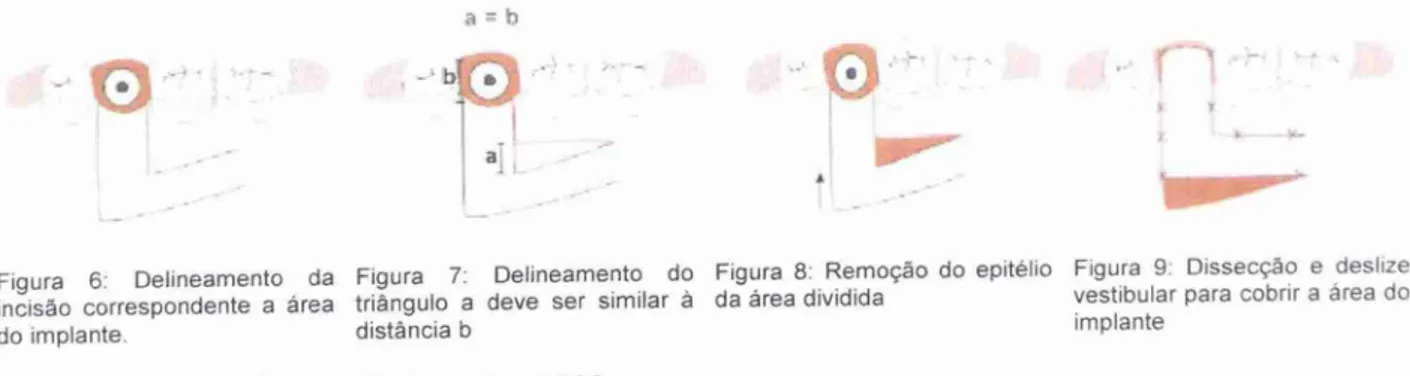 Figura  6:  Delineamento da Figura 7: Delineamento do Figura  8: Remoção  do  epitelio  Figura  9: Dissecção  e  deslize  incisão  correspondente a area  triângulo  a deve ser similar a da area dividida  vestibular para cobrir a area do 